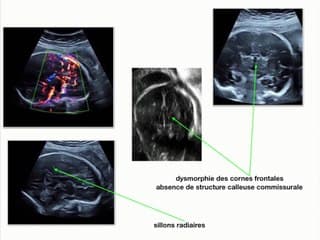 Dysgénésies du corps calleux Sémiologie échographique : corps calleux normal et pathologique
