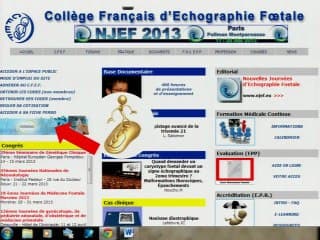 Intérêt des marqueurs sériques du 1er trimestre chez les foetus ayant une clarté de la nuque augmentée.