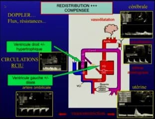 Hémodynamique d'un bien être foetale