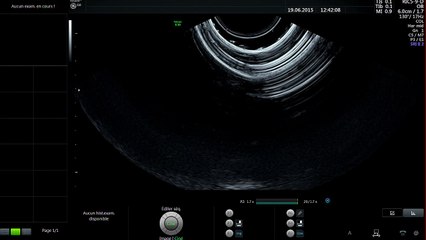 Démonstration live : Mesurer le col utérin.