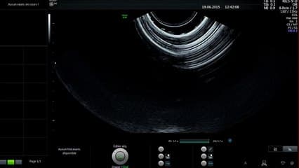 Démonstration live : Mesurer le col utérin.