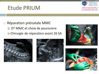 Réparation chirurgicale in utero des myéloméningocèles