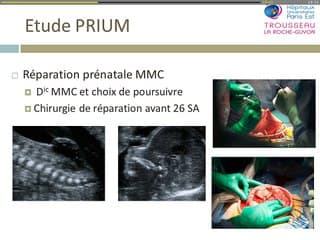 Réparation chirurgicale in utero des myéloméningocèles