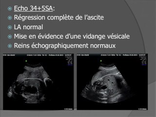 Une ascite foetale : les examens radiologiques et biologiques pris à défaut.