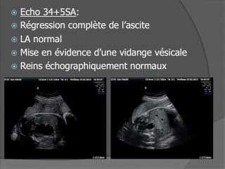 Une ascite foetale : les examens radiologiques et biologiques pris à défaut.