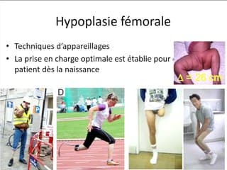 Que faire et que dire devant une incurvation des membres inférieurs