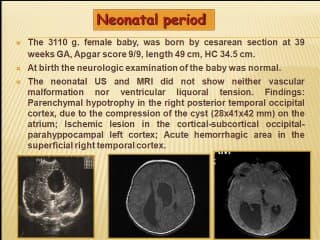 agenesie du corps calleux et maladie de RENDU OSLER ( en ANGLAIS )