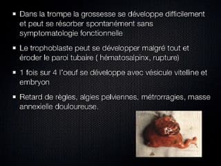 Pathologies gynécologiques et grossesse  Grossesse extra-utérine, un diagnostic toujours difficile ?