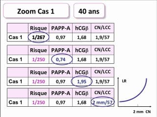 Bilan national du dépistage de la trisomie 21 par le risque combiné du 1er trimestre Le biologiste