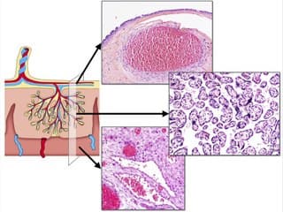 retard de croissance intra utérin : placenta et rciu