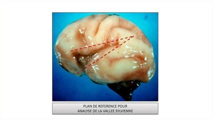 Surface corticale en imagerie foetale : du dépistage au diagnostic