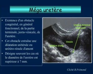 Uropathies