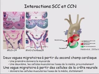 Le conotroncus et ses pathologies :embryologie  Fallot, VDDI, DiGeorge, atrésie pulmonaire