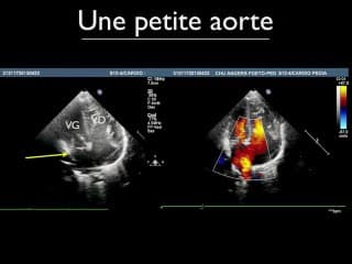 Diagnostic prénatal du coeur triatrial : de la science fiction ?