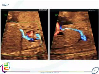 Agénésie du ductus veineux et shunt ombilico-systémique: intérêt du diagnostic anténatal dans l’établissement du pronostic postnatal