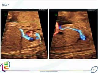 Agénésie du ductus veineux et shunt ombilico-systémique: intérêt du diagnostic anténatal dans l’établissement du pronostic postnatal