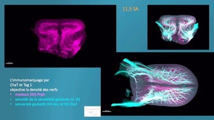 La langue, clé du diagnostic échographique précoce embryo-foetal des séquences de Pierre Robin