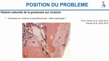 PATHOLOGIE DE LA CICATRICE : Grossesse sur cicatrice de césarienne et grossesse cervicale