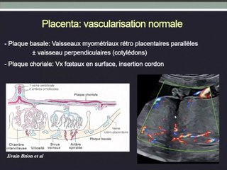 Placenta et Cordon coraux et pathologiques, l’essentiel