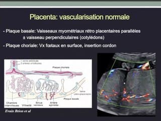 Placenta et Cordon coraux et pathologiques, l’essentiel