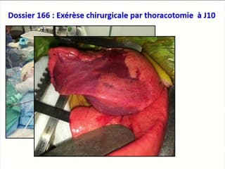 Malformations bronchopulmonaires : un dépistage efficace, pour quel pronostic ? Confrontations des données anté et post-natales.