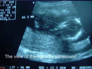 Embryohystéroscopie dans le bilan de FCS