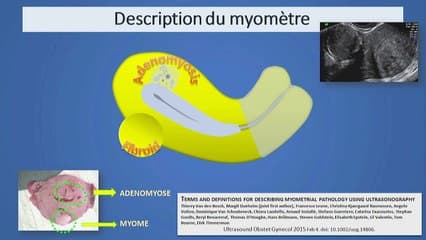 Adénomyose : échographie