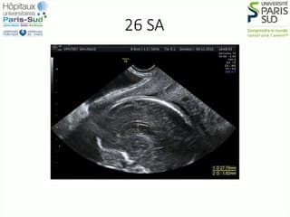 Toxoplasmose congénitale grave chez une patiente immunodéprimée: rare cas de faux négatif.