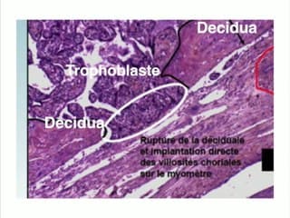 PATHOLOGIE DE LA CICATRICE : Placentas accreta et percreta : conséquence d’une implantation sur cicatrice de césarienne ?