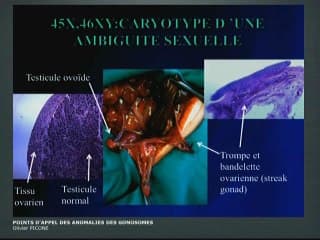 Anomalies des organes génitaux externe : Points d’appel des anomalies des gonosomes