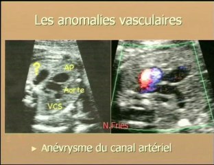 Les masses médiastinales