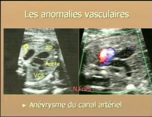 Les masses médiastinales