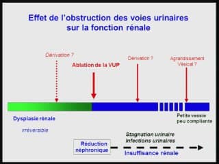 Valve de l'urèthre postérieur :  évaluation à long terme.