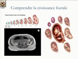 échographie de fusion