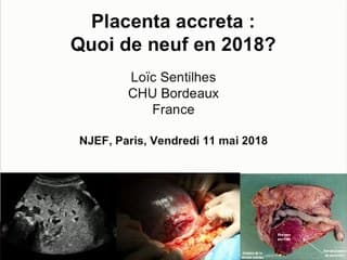 Placenta accreta, quoi de neuf ?