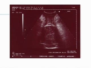 Diagnostic échographique d’engagement