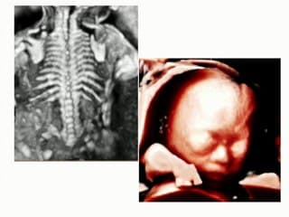 Prenatal Diagnosis of Desbuquois Dysplasia by Whole Exome Sequencing Before the Occurrence of Specific Ultrasound Signs