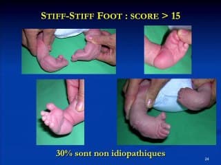 De la malposition à la malformation du pied... le foetus est aujourd'hui en garde à_ vue