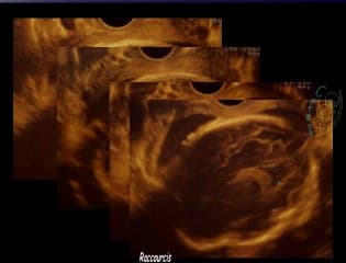 Chondrodysplasie ponctuée