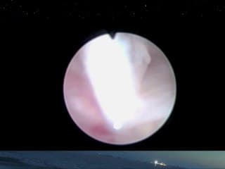 Où faut-il faire naître les enfants suspects de VUP ? Est-ce une urgence ? Faut-il refaire une échographie, une cystographie ? Quand faut-il les opérer ? Faut-il laisser une sonde ? Administrer des antibiotiques ??