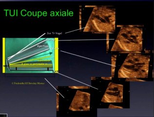 Coeur et STIC