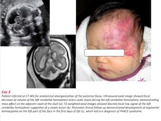 Diagnostic prenatal d'une hypoplasie unilatérale du cervelet : à propos d' une serie de 25 cas