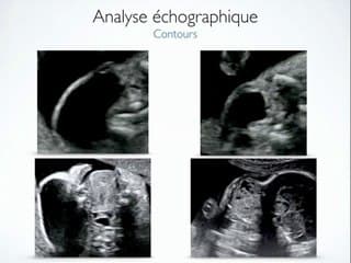 Evaluation pronostique d'une tumeur du cou foetal : apport de l'imagerie.