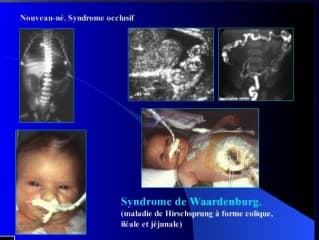 Ce que vous devez savoir pour comprendre la pathologie du tube digestif foetal