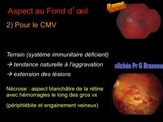 Infection et anomalies oculaires