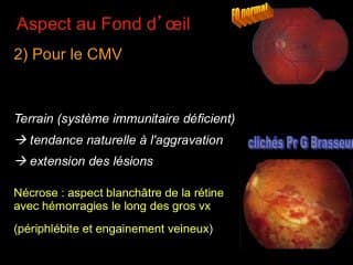 Infection et anomalies oculaires
