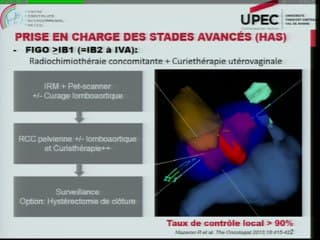Échographie du cancer du col de l'utérus Discussion de l'impact clinique de l'imagerie échographique dans la prise en charge des cancers du col