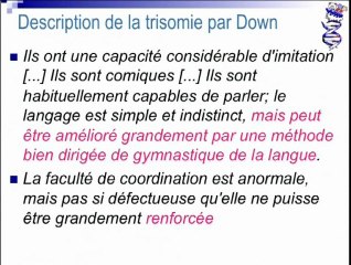 Histoire de la Trisomie 21