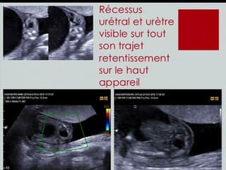 cas cliniques mégavessies