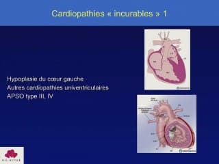 Les cardiopathies de dépistage tardif
